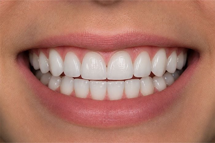 Cosmetic-Composite-Bonding-Path-after